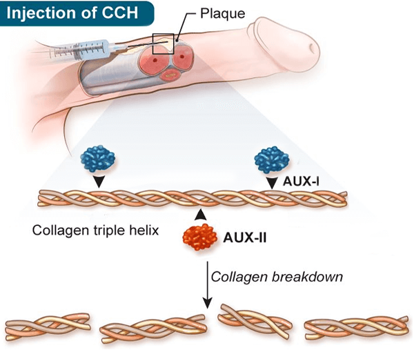 Trattamento: injection of CCH